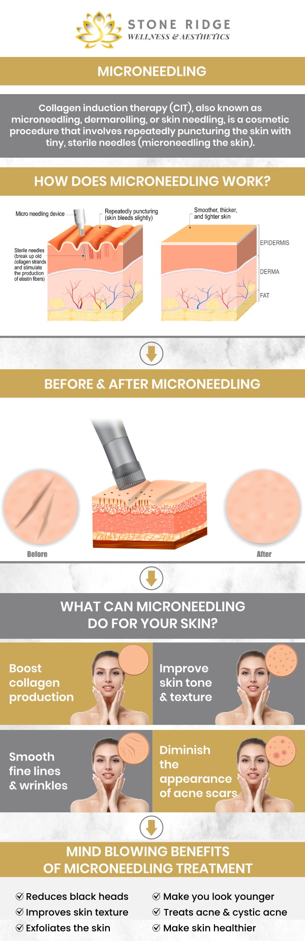 At Stone Ridge Wellness and Aesthetics, we understand how persistent acne scars can impact your self-esteem long after the breakouts have cleared. Under the guidance of Dr. Ria Shirsolkar, MD, MS, we offer advanced microneedling treatments designed to resurface the skin and restore a smooth, radiant complexion. This minimally invasive procedure leverages the body’s natural healing power to remodel scar tissue from the inside out, providing a science-backed solution for those seeking to reclaim their skin’s natural texture. For more information, contact us or request an appointment online. We are conveniently located at 24560 Southpoint Dr, Suite 220 Aldie, VA 20105. At Stone Ridge Wellness and Aesthetics, we understand how persistent acne scars can impact your self-esteem long after the breakouts have cleared. Under the guidance of Dr. Ria Shirsolkar, MD, MS, we offer advanced microneedling treatments designed to resurface the skin and restore a smooth, radiant complexion. This minimally invasive procedure leverages the body’s natural healing power to remodel scar tissue from the inside out, providing a science-backed solution for those seeking to reclaim their skin’s natural texture. For more information, contact us or request an appointment online. We are conveniently located at 24560 Southpoint Dr, Suite 220 Aldie, VA 20105.