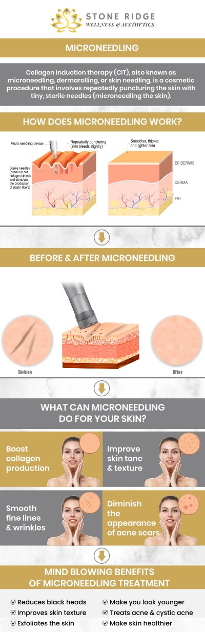 At Stone Ridge Wellness and Aesthetics, we understand how persistent acne scars can impact your self-esteem long after the breakouts have cleared. Under the guidance of Dr. Ria Shirsolkar, MD, MS, we offer advanced microneedling treatments designed to resurface the skin and restore a smooth, radiant complexion. This minimally invasive procedure leverages the body’s natural healing power to remodel scar tissue from the inside out, providing a science-backed solution for those seeking to reclaim their skin’s natural texture. For more information, contact us or request an appointment online. We are conveniently located at 24560 Southpoint Dr, Suite 220 Aldie, VA 20105. At Stone Ridge Wellness and Aesthetics, we understand how persistent acne scars can impact your self-esteem long after the breakouts have cleared. Under the guidance of Dr. Ria Shirsolkar, MD, MS, we offer advanced microneedling treatments designed to resurface the skin and restore a smooth, radiant complexion. This minimally invasive procedure leverages the body’s natural healing power to remodel scar tissue from the inside out, providing a science-backed solution for those seeking to reclaim their skin’s natural texture. For more information, contact us or request an appointment online. We are conveniently located at 24560 Southpoint Dr, Suite 220 Aldie, VA 20105.